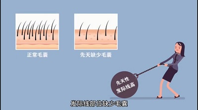 头发种植吗如果是秃顶植发